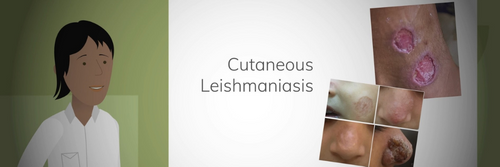 皮肤利什曼病横幅的Youtube演示幻灯片