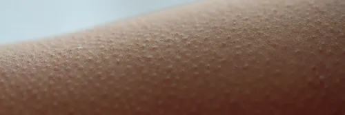 Goosebumps on an arm