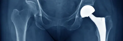 An x-ray of a hip replacement