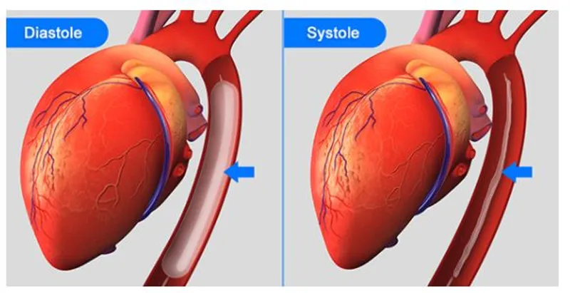 intra-aortic-balloon-pump (IABP)