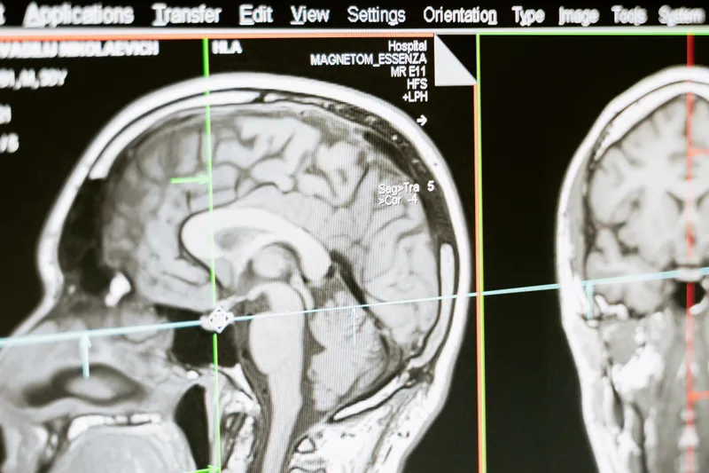 A computer monitor displaying an MRI brain scan