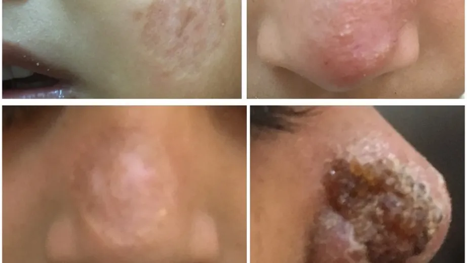 4 faces of Cutaneous leishmaniasis